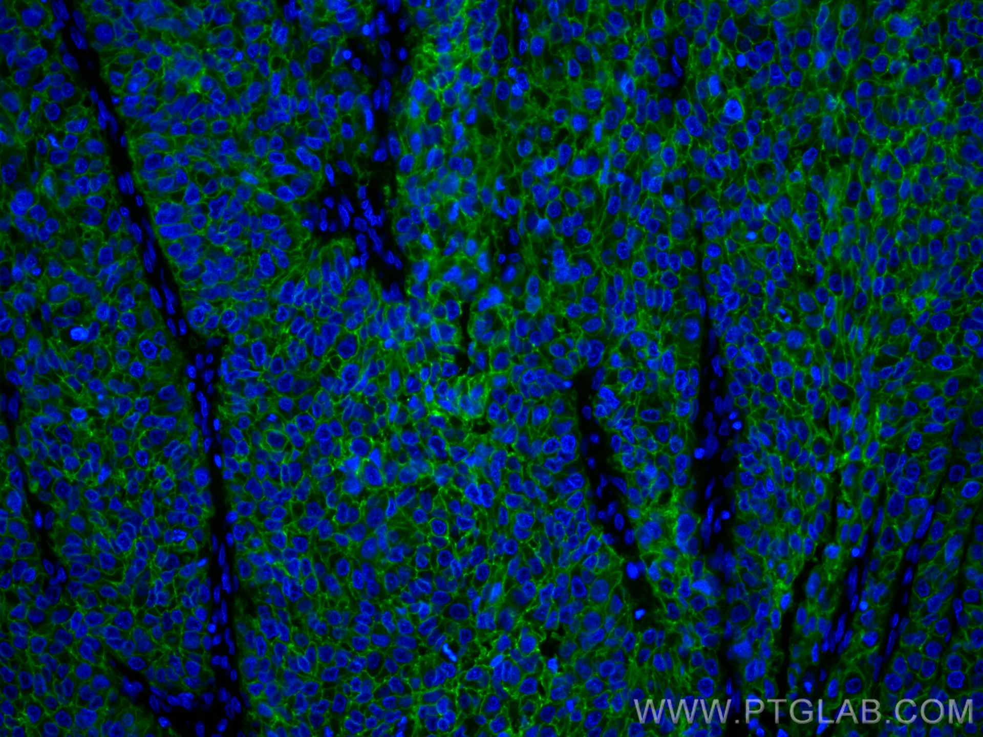 Immunofluorescence (IF) / fluorescent staining of human stomach cancer tissue using EPCAM/CD326 Monoclonal antibody (66316-1-Ig)