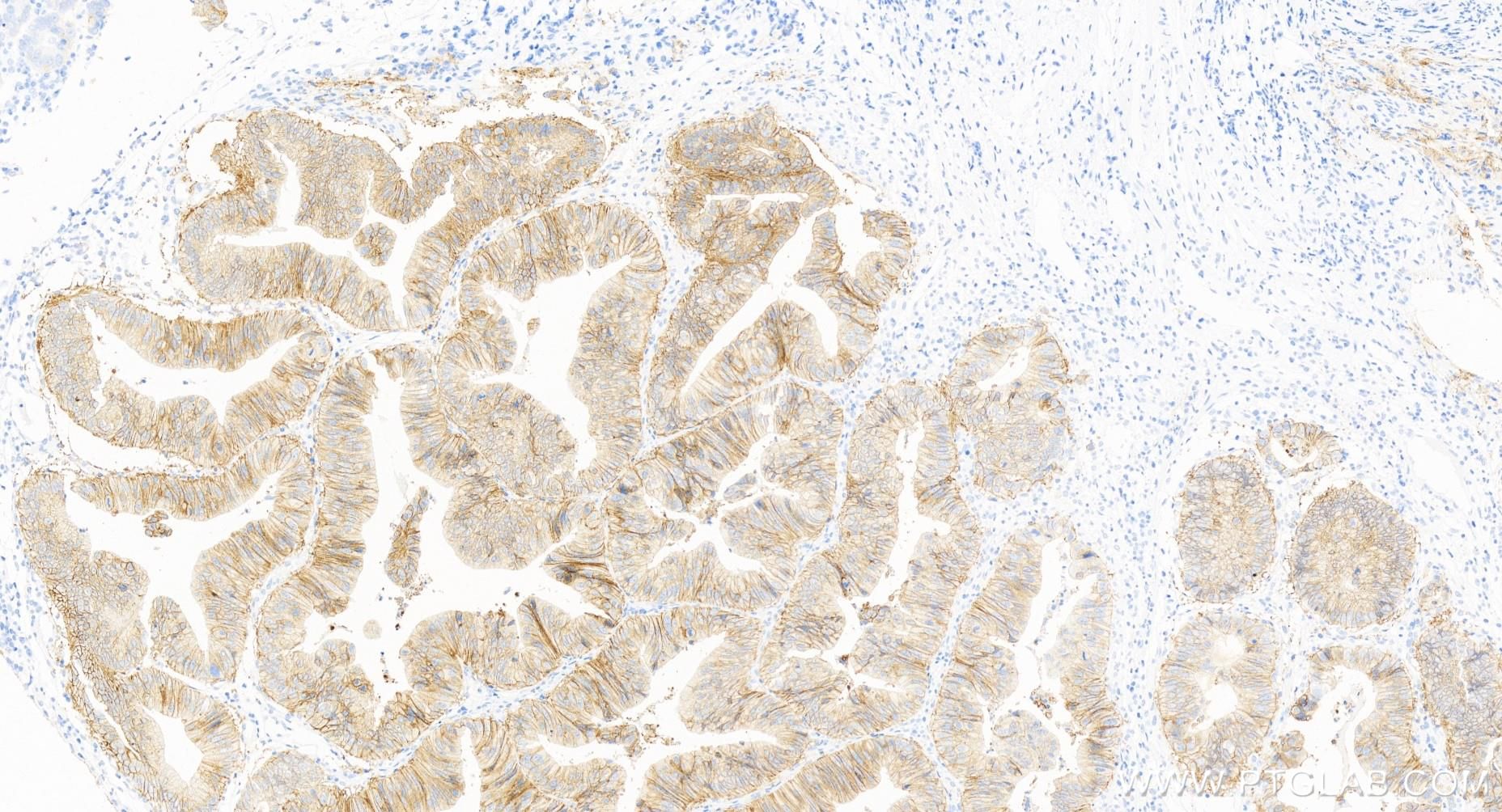 Immunohistochemistry (IHC) staining of human ovary cancer tissue using EPCAM/CD326 Recombinant antibody (84073-6-RR)