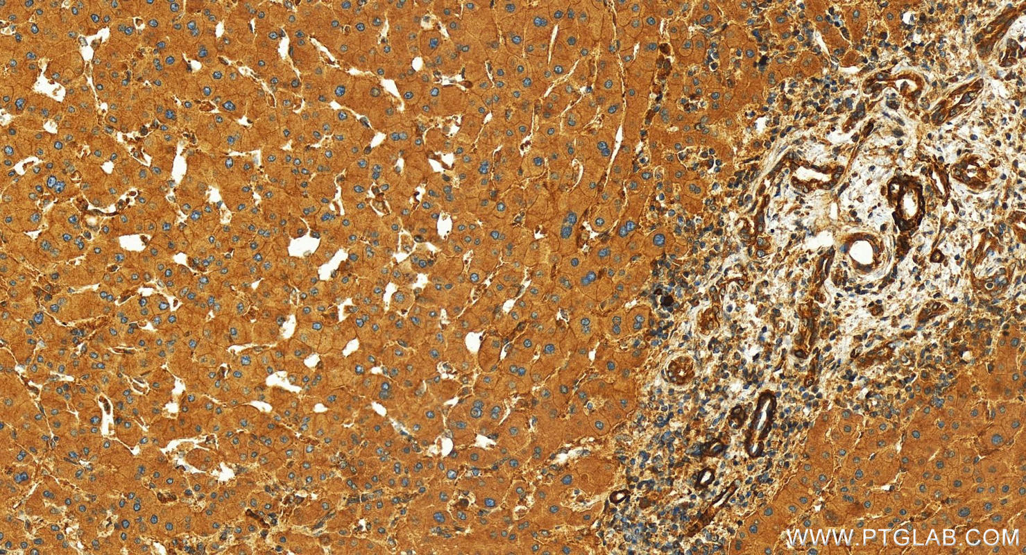 Immunohistochemistry (IHC) staining of human intrahepatic cholangiocarcinoma tissue using EPS15R Polyclonal antibody (21243-1-AP)