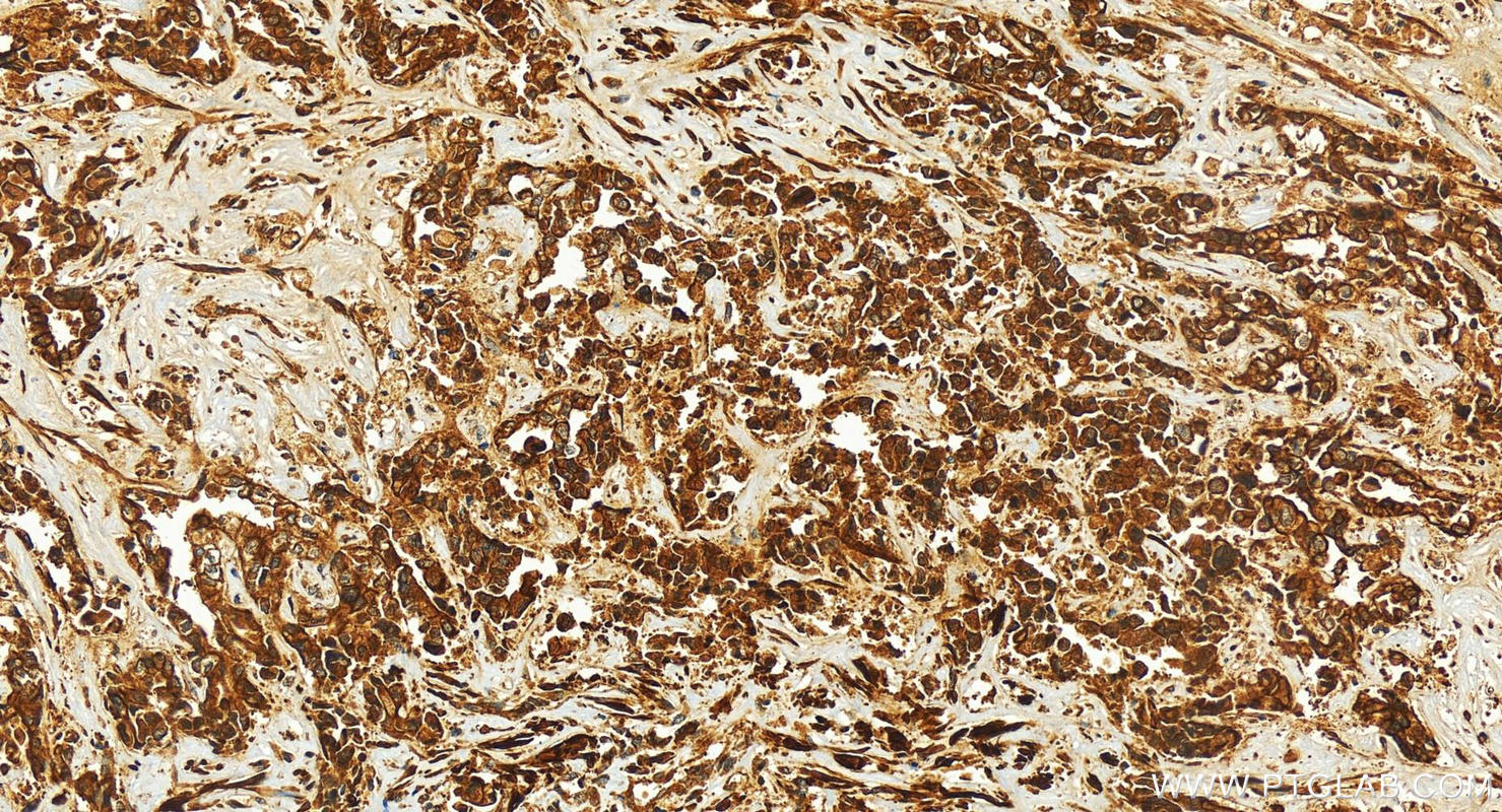 Immunohistochemistry (IHC) staining of human intrahepatic cholangiocarcinoma tissue using EPS15R Polyclonal antibody (21243-1-AP)