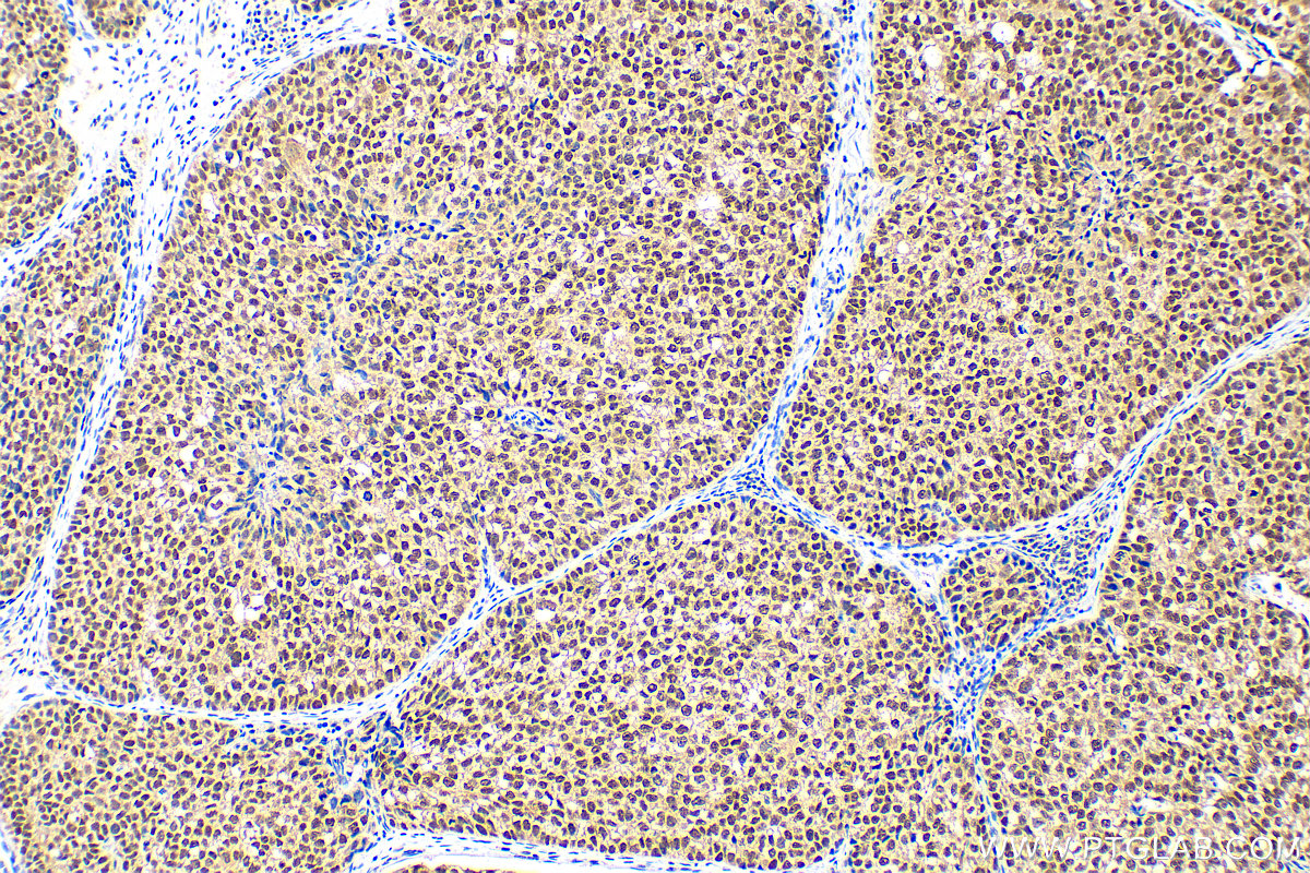 Immunohistochemistry (IHC) staining of human breast cancer tissue using ER Polyclonal antibody (20698-1-AP)