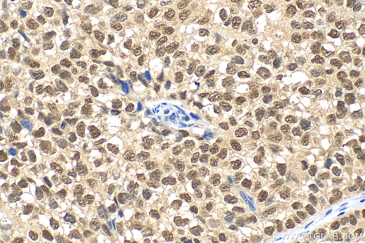 Immunohistochemistry (IHC) staining of human breast cancer tissue using ER Polyclonal antibody (20698-1-AP)