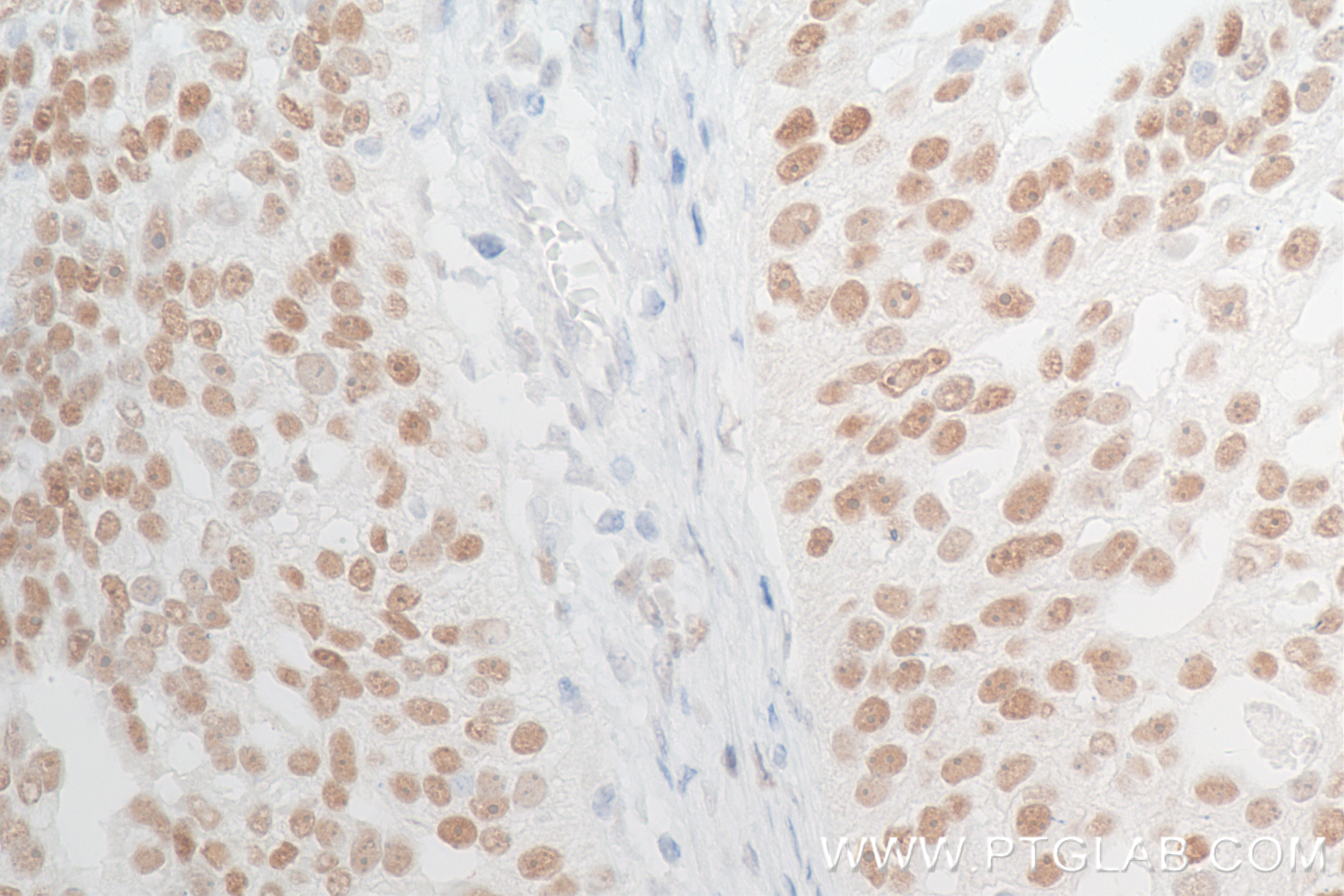 Immunohistochemistry (IHC) staining of human ovary cancer tissue using ER Recombinant antibody (84564-4-RR)