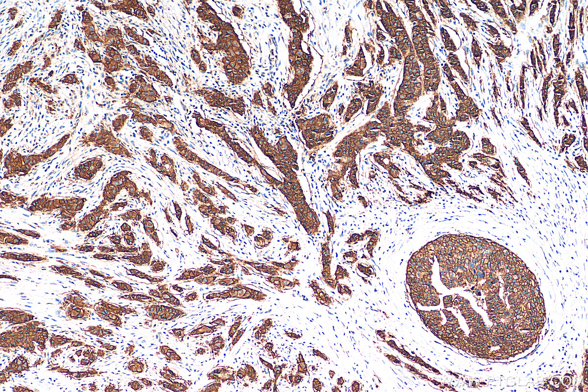 Immunohistochemistry (IHC) staining of human breast cancer tissue using HER2/ErbB2 Polyclonal antibody (18299-1-AP)