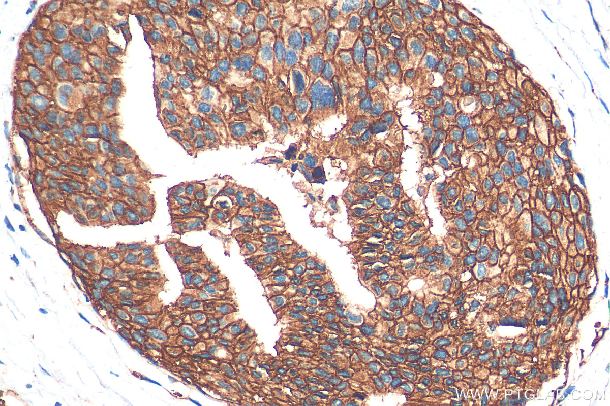 Immunohistochemistry (IHC) staining of human breast cancer tissue using HER2/ErbB2 Polyclonal antibody (18299-1-AP)