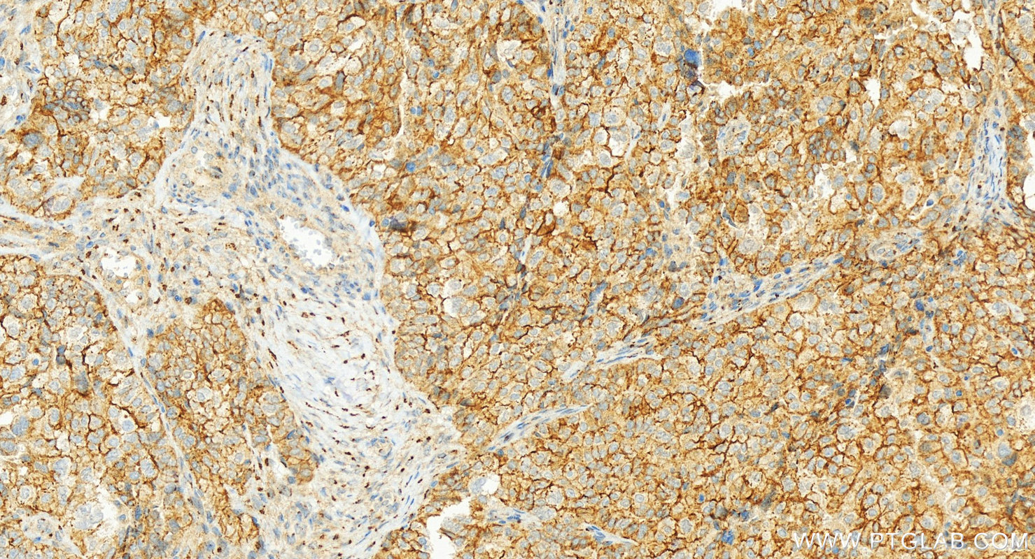 Immunohistochemistry (IHC) staining of human ovary cancer tissue using HER2/ErbB2 Polyclonal antibody (18299-1-AP)