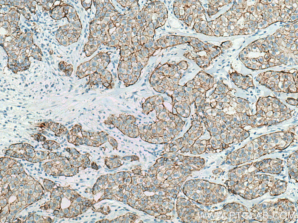 Immunohistochemistry (IHC) staining of human breast cancer tissue using HER2/ErbB2 Monoclonal antibody (60311-1-Ig)