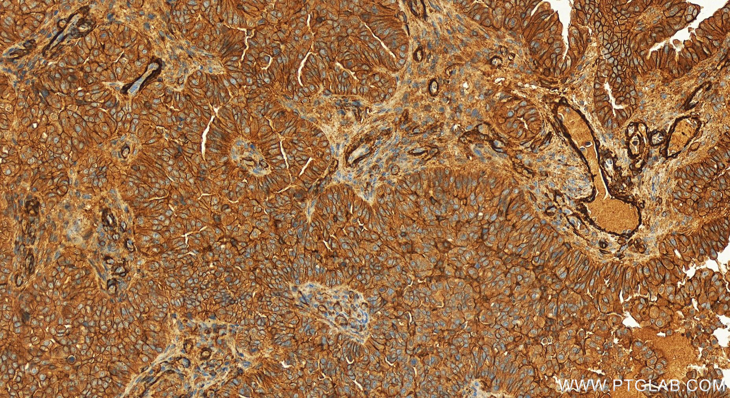 Immunohistochemistry (IHC) staining of human ovarian  cancer using HER2/ErbB2,p185-Specific Recombinant antibody (84046-1-RR)