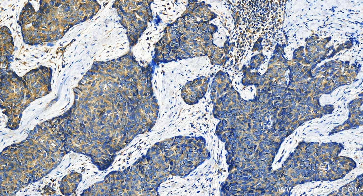 Immunohistochemistry (IHC) staining of human bowen disease using ERC2 Polyclonal antibody (21396-1-AP)