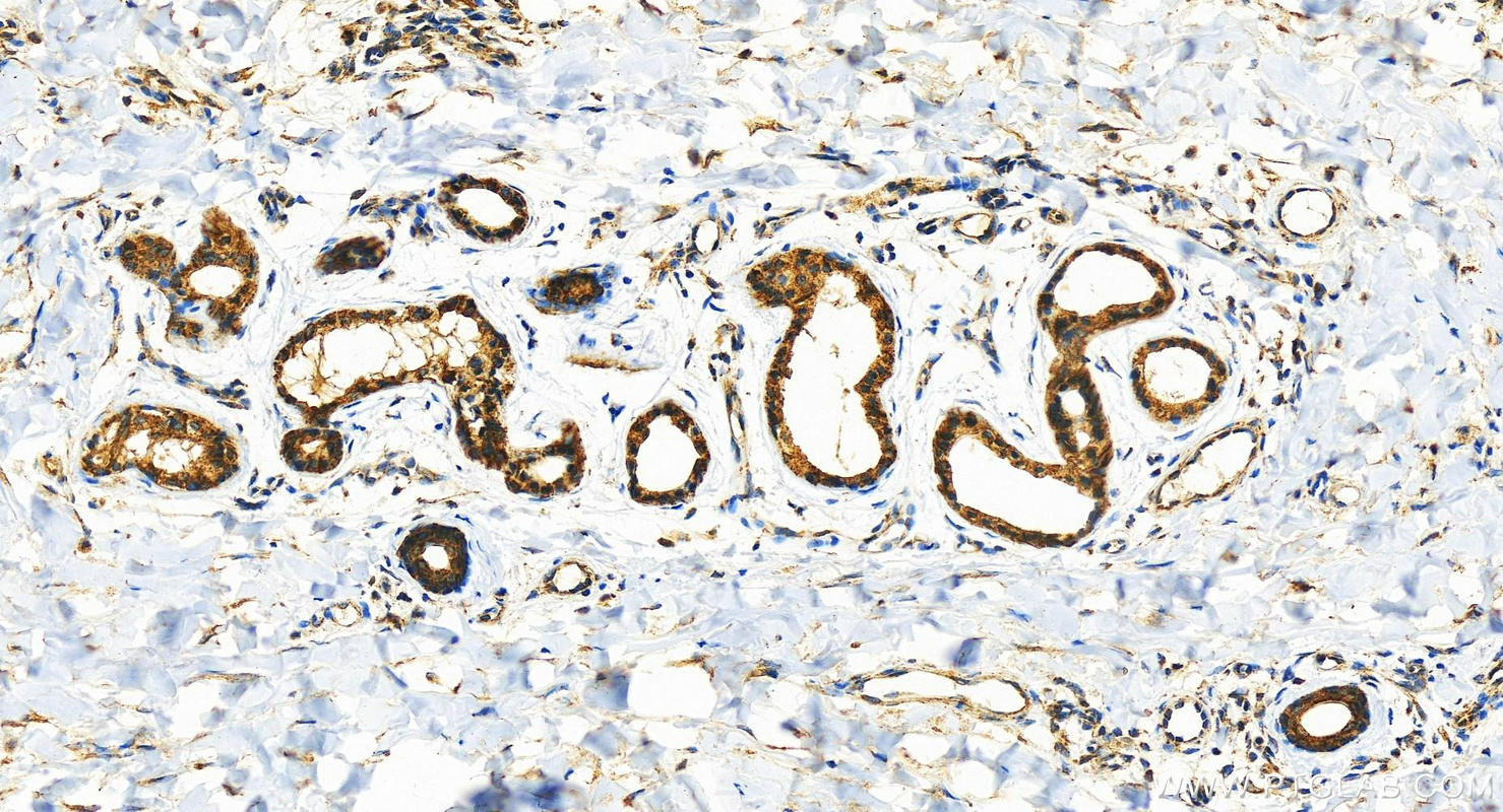 Immunohistochemistry (IHC) staining of human bowen disease using ERC2 Polyclonal antibody (21396-1-AP)