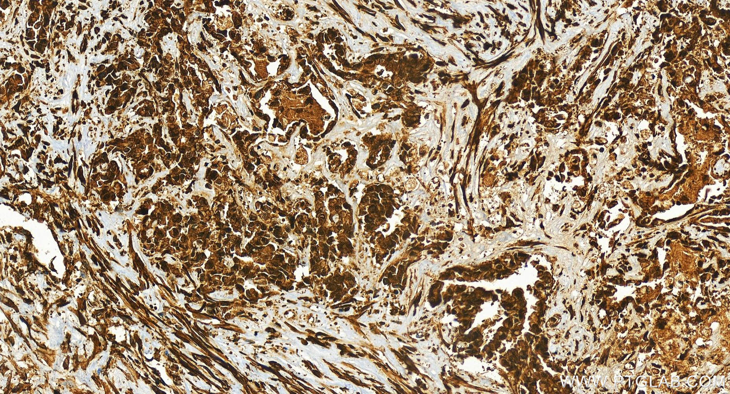 Immunohistochemistry (IHC) staining of human intrahepatic cholangiocarcinoma tissue using ERK1/2 Recombinant antibody (83533-1-RR)