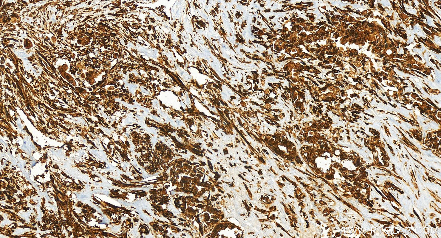 Immunohistochemistry (IHC) staining of human intrahepatic cholangiocarcinoma tissue using ERK1/2 Recombinant antibody (83533-1-RR)