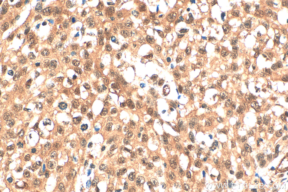 Immunohistochemistry (IHC) staining of human cervical cancer tissue using ERK1/2 Recombinant antibody (83533-1-RR)