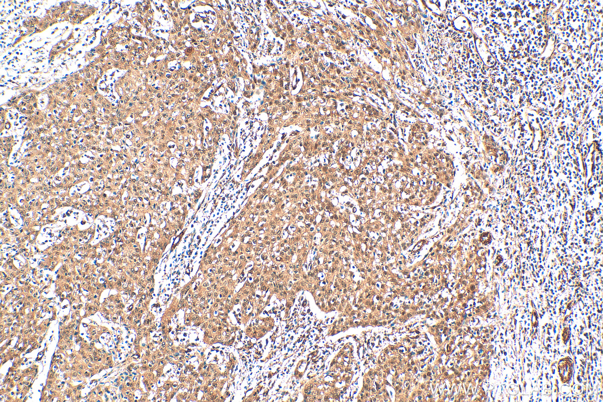 Immunohistochemistry (IHC) staining of human cervical cancer tissue using ERK1/2 Recombinant antibody (83533-1-RR)