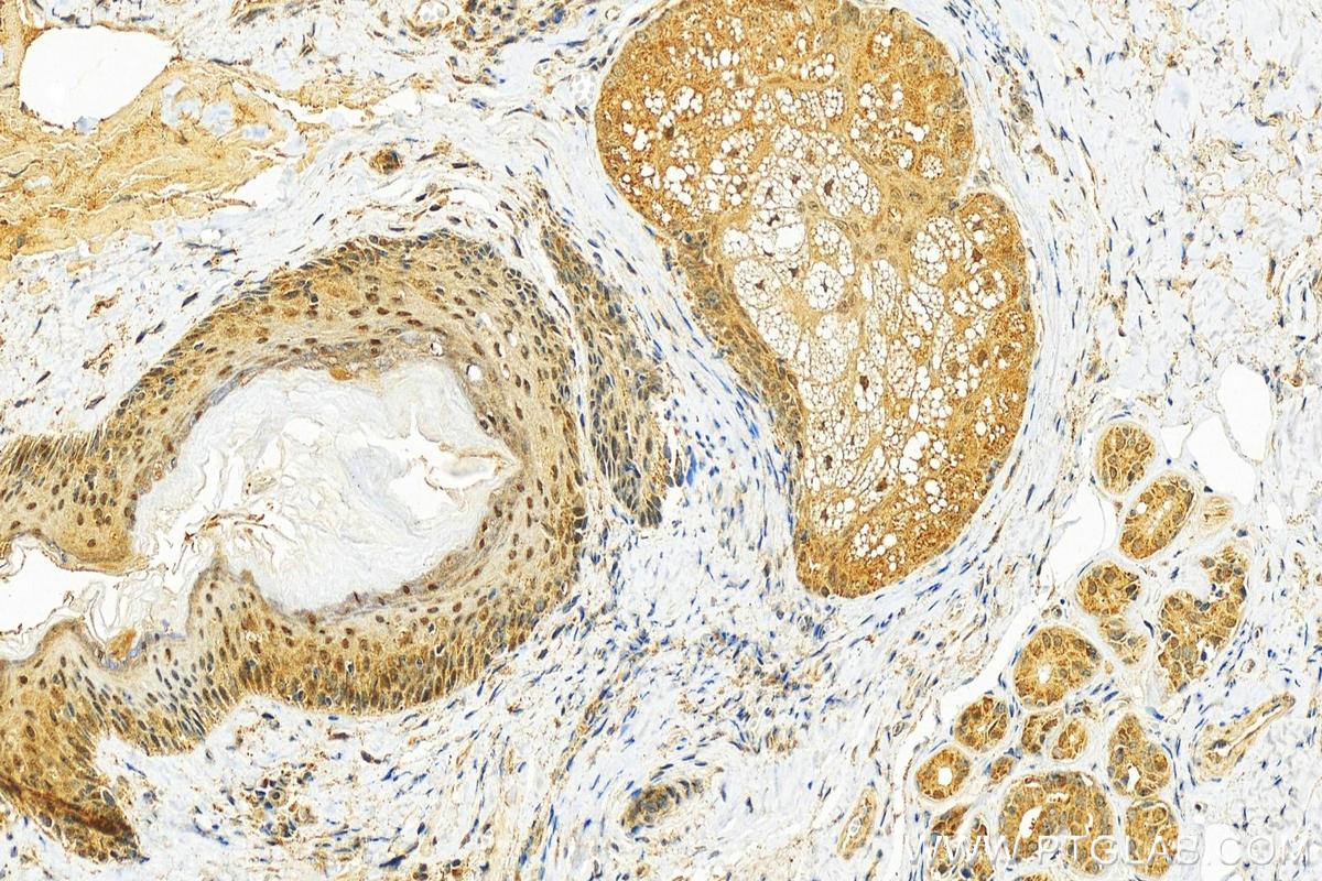 Immunohistochemistry (IHC) staining of human skin cancer tissue using ESCO2 Polyclonal antibody (23525-1-AP)