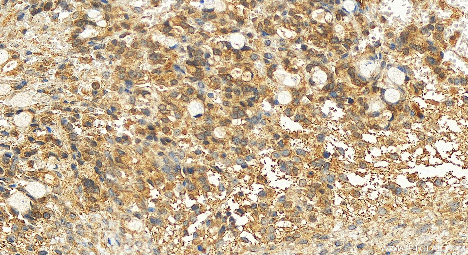 Immunohistochemistry (IHC) staining of human ovary cancer tissue using ESPN Polyclonal antibody (20717-1-AP)