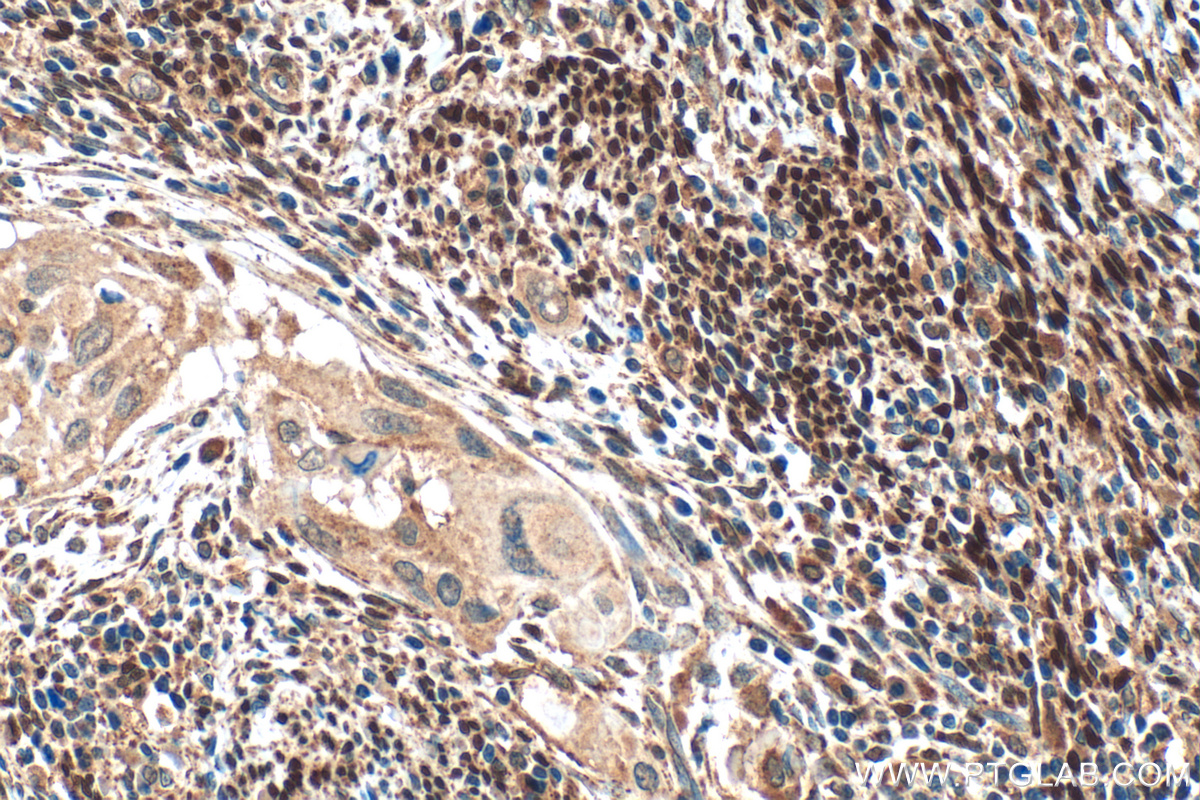 Immunohistochemistry (IHC) staining of human cervical cancer tissue using ER Polyclonal antibody (21244-1-AP)