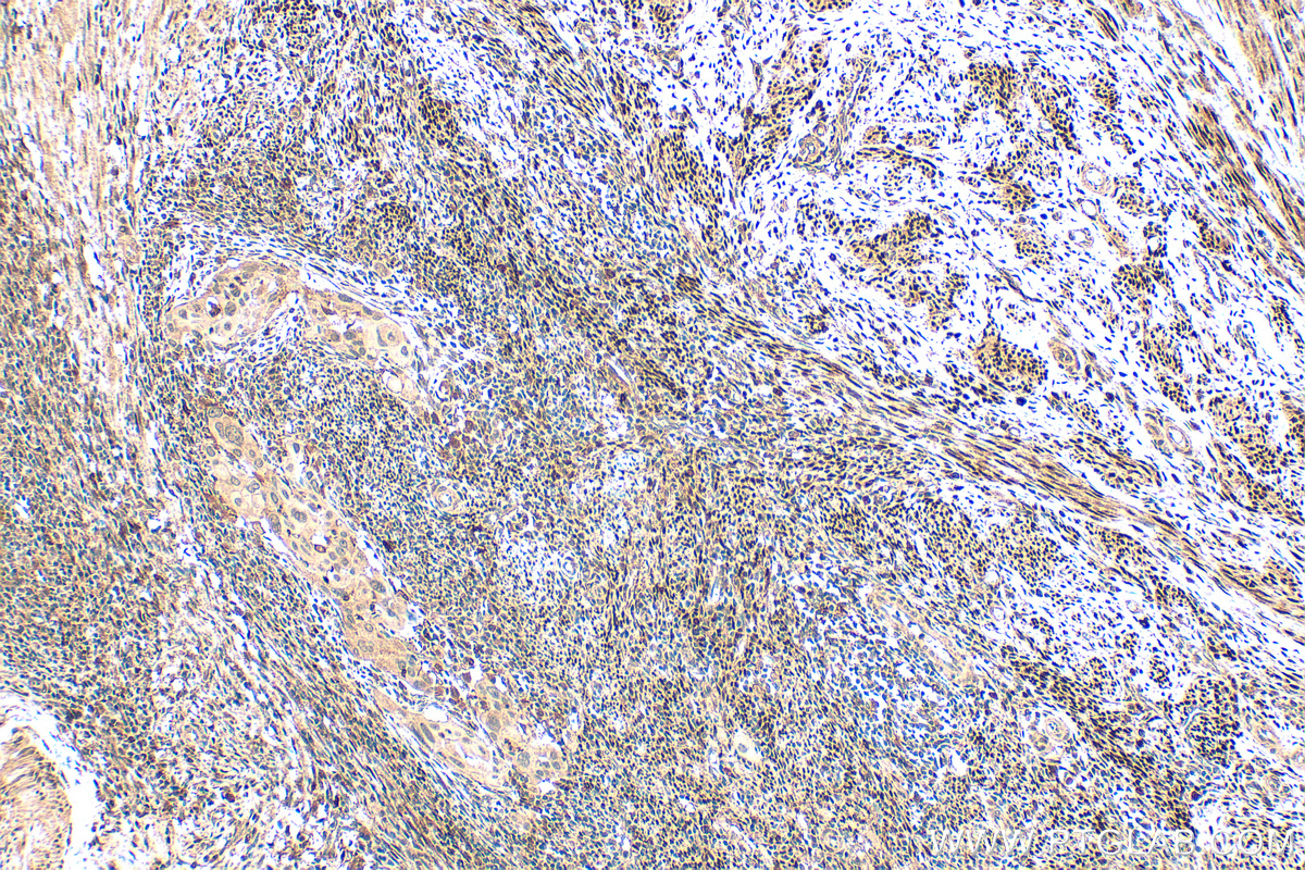 Immunohistochemistry (IHC) staining of human cervical cancer tissue using ER Polyclonal antibody (21244-1-AP)