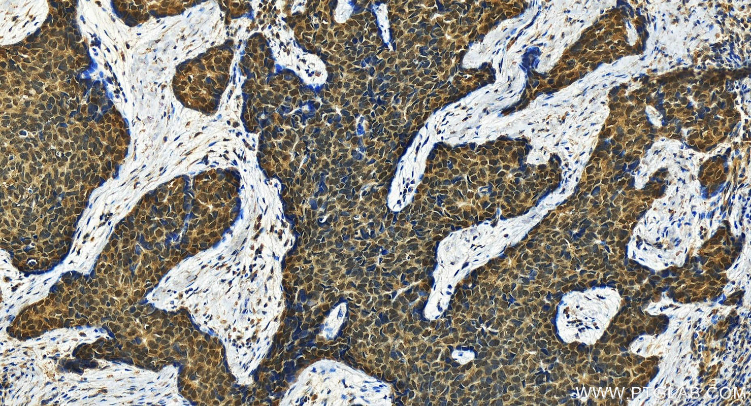 Immunohistochemistry (IHC) staining of human bowen disease using ESRP1 Polyclonal antibody (21045-1-AP)