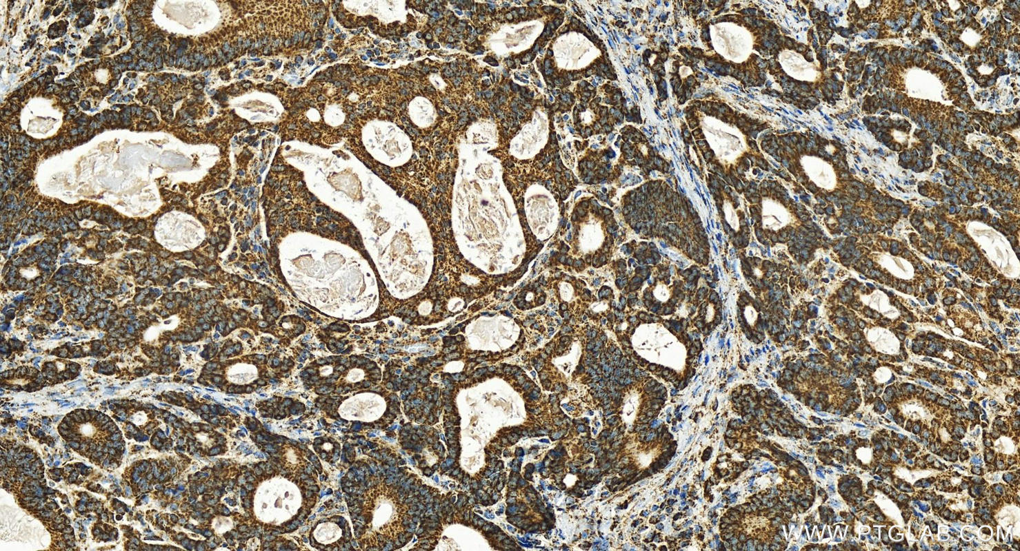 Immunohistochemistry (IHC) staining of human stomach cancer tissue using ETFB Polyclonal antibody (17925-1-AP)