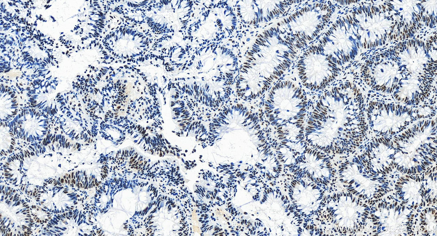 Immunohistochemistry (IHC) staining of human colon cancer tissue using ETV4 Recombinant antibody (83891-6-RR)