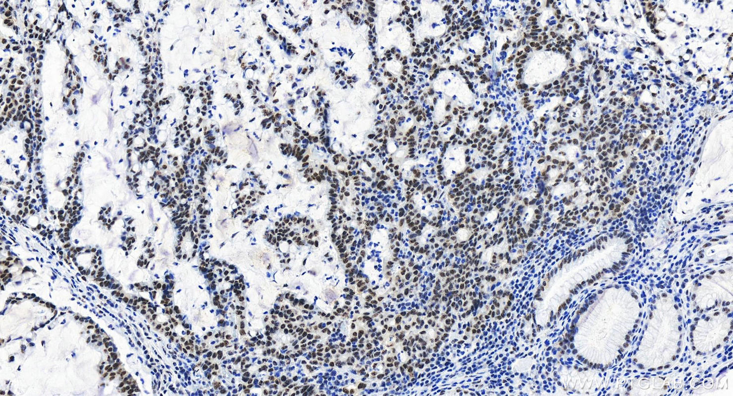 Immunohistochemistry (IHC) staining of human stomach cancer tissue using ETV4 Recombinant antibody (83891-6-RR)