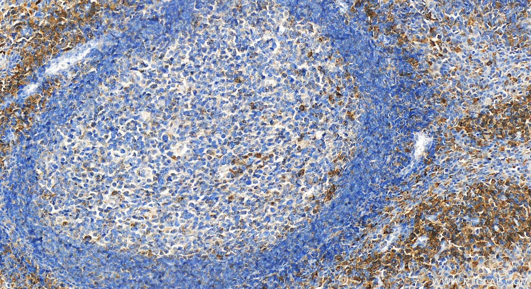 Immunohistochemistry (IHC) staining of human tonsillitis tissue using EVI2B Polyclonal antibody (24891-1-AP)