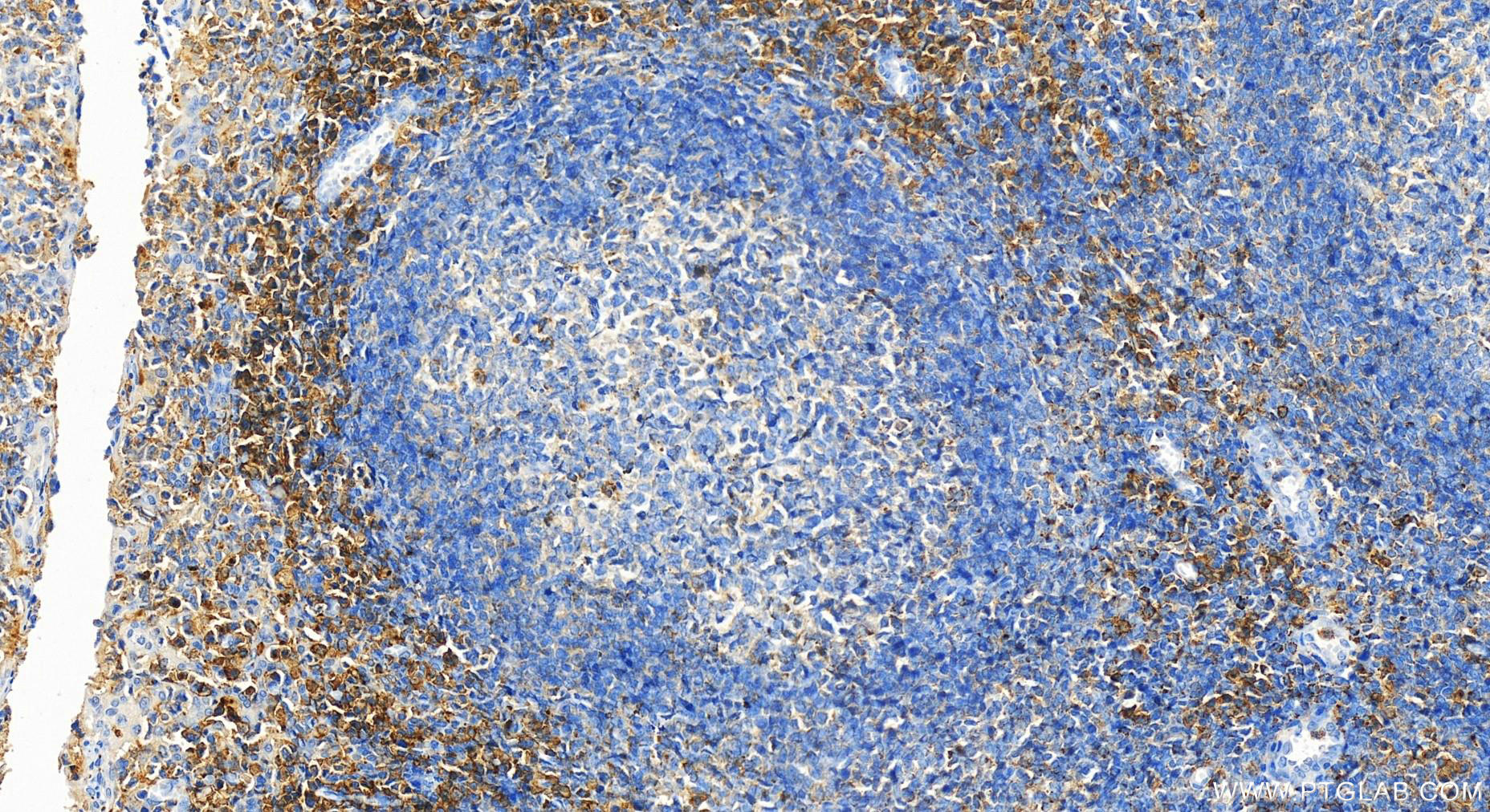 Immunohistochemistry (IHC) staining of human tonsillitis tissue using EVI2B Polyclonal antibody (24891-1-AP)