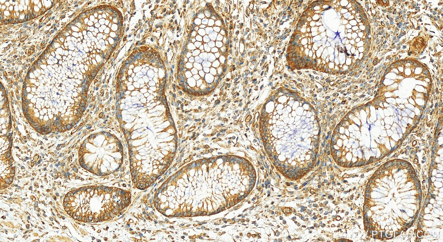 Immunohistochemistry (IHC) staining of human colon cancer tissue using Sec8 Polyclonal antibody (11913-1-AP)