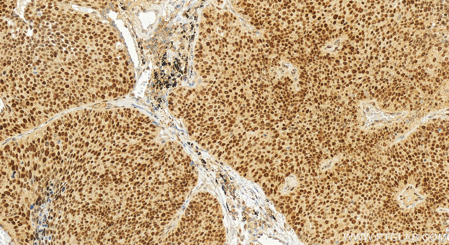 Immunohistochemistry (IHC) staining of human lung squamous cell carcinoma tissue using EZH2 Polyclonal antibody (21800-1-AP)