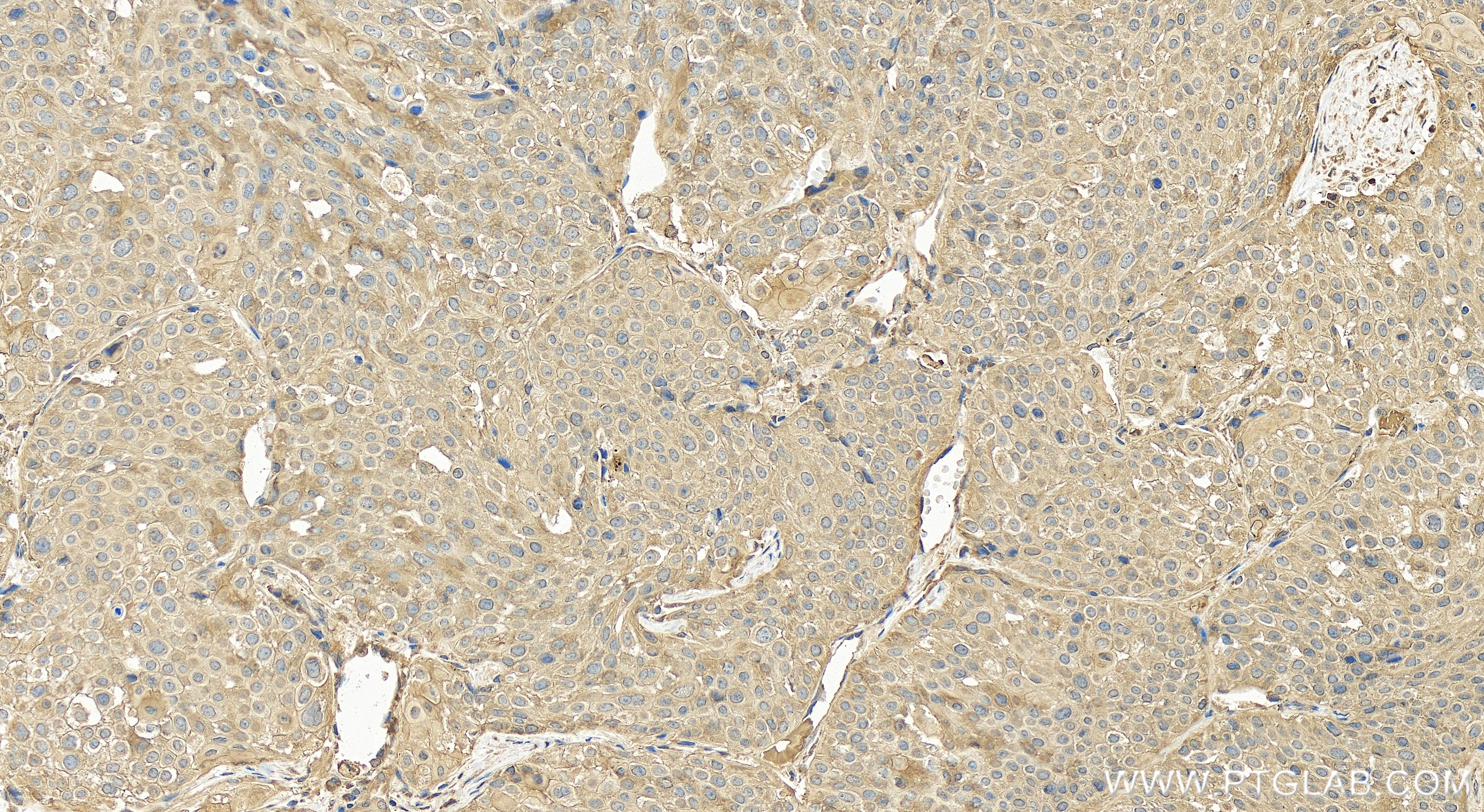 Immunohistochemistry (IHC) staining of human lung cancer tissue using Eg5 Recombinant antibody (84966-2-RR)