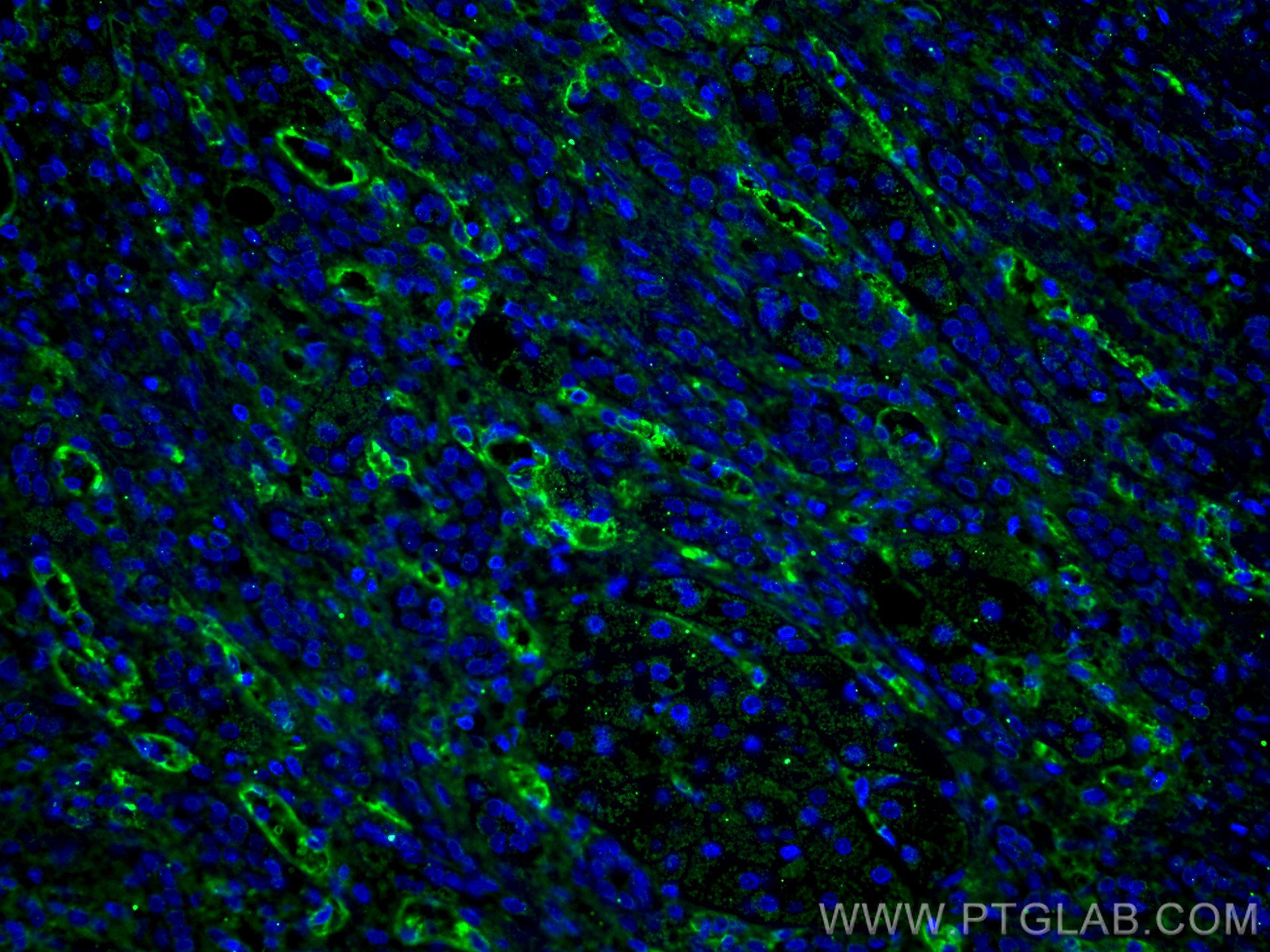 Immunofluorescence (IF) / fluorescent staining of human liver cancer tissue using Endoglin/CD105 Monoclonal antibody (67075-1-Ig)