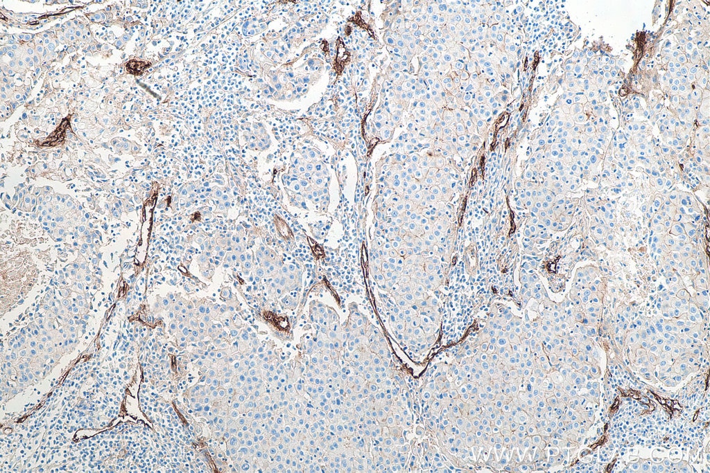 Immunohistochemistry (IHC) staining of human breast cancer tissue using Endoglin/CD105 Monoclonal antibody (67075-1-Ig)