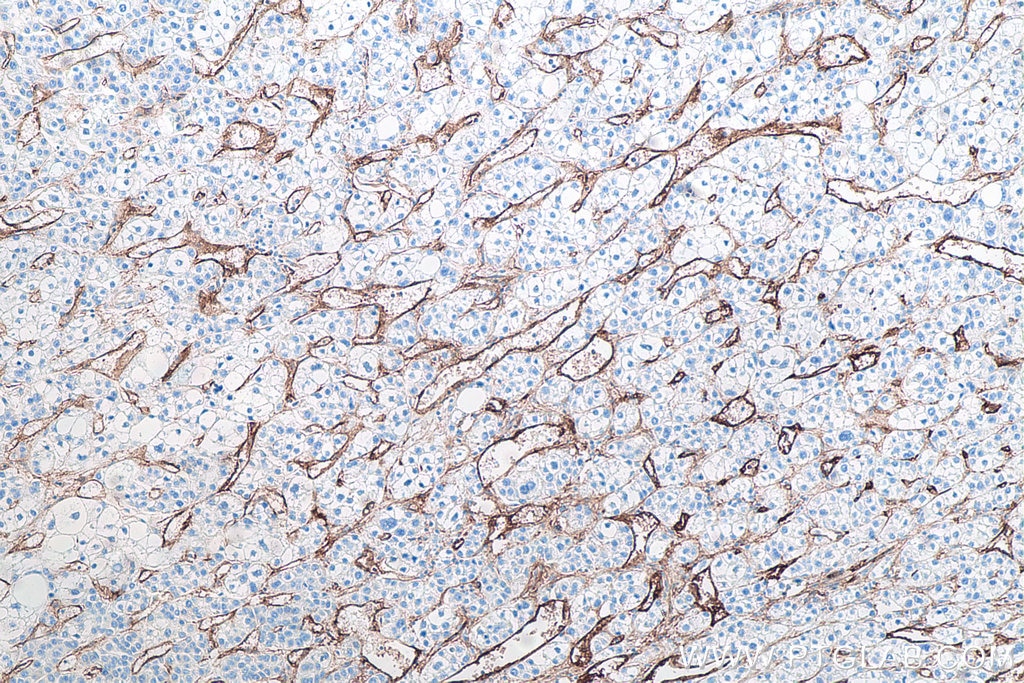 Immunohistochemistry (IHC) staining of human liver cancer tissue using Endoglin/CD105 Monoclonal antibody (67075-1-Ig)