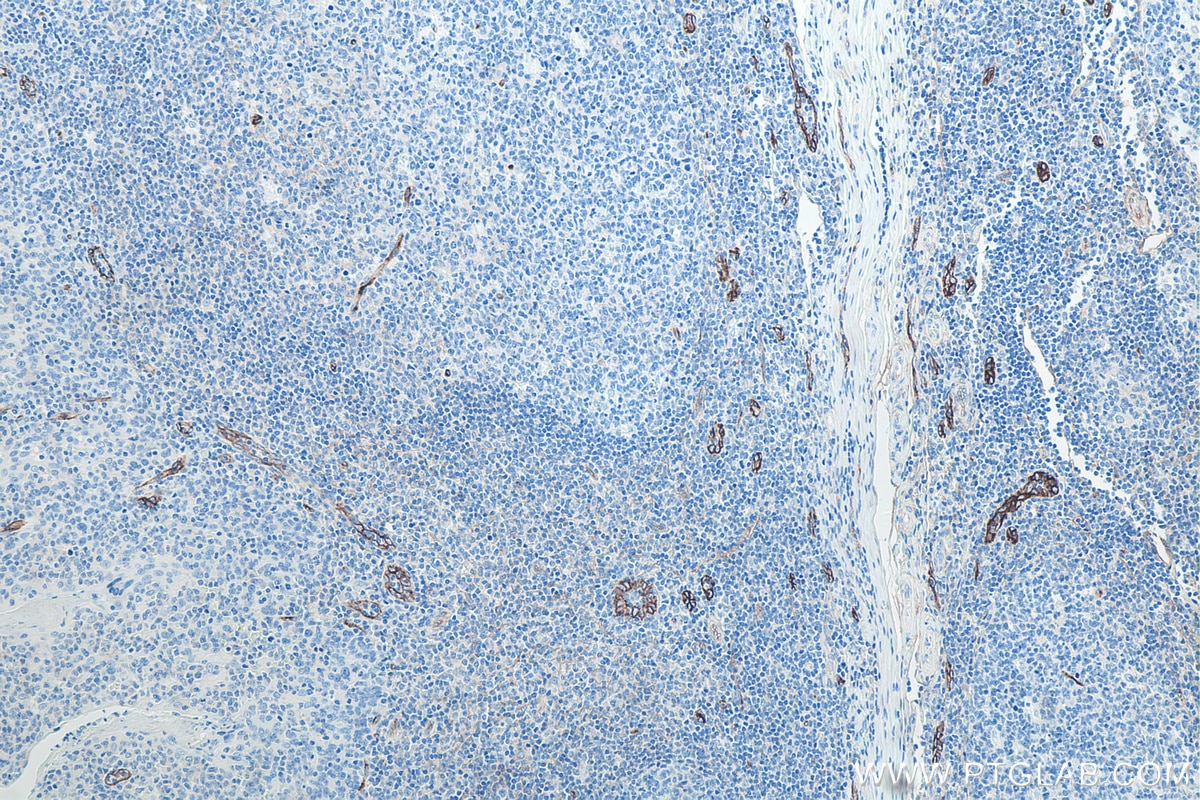 Immunohistochemistry (IHC) staining of human tonsillitis tissue using Endoglin/CD105 Monoclonal antibody (67075-1-Ig)
