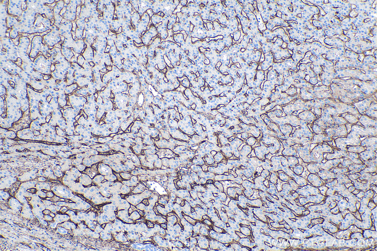 Immunohistochemistry (IHC) staining of human liver cancer tissue using Endoglin/CD105 Monoclonal antibody (67075-1-Ig)