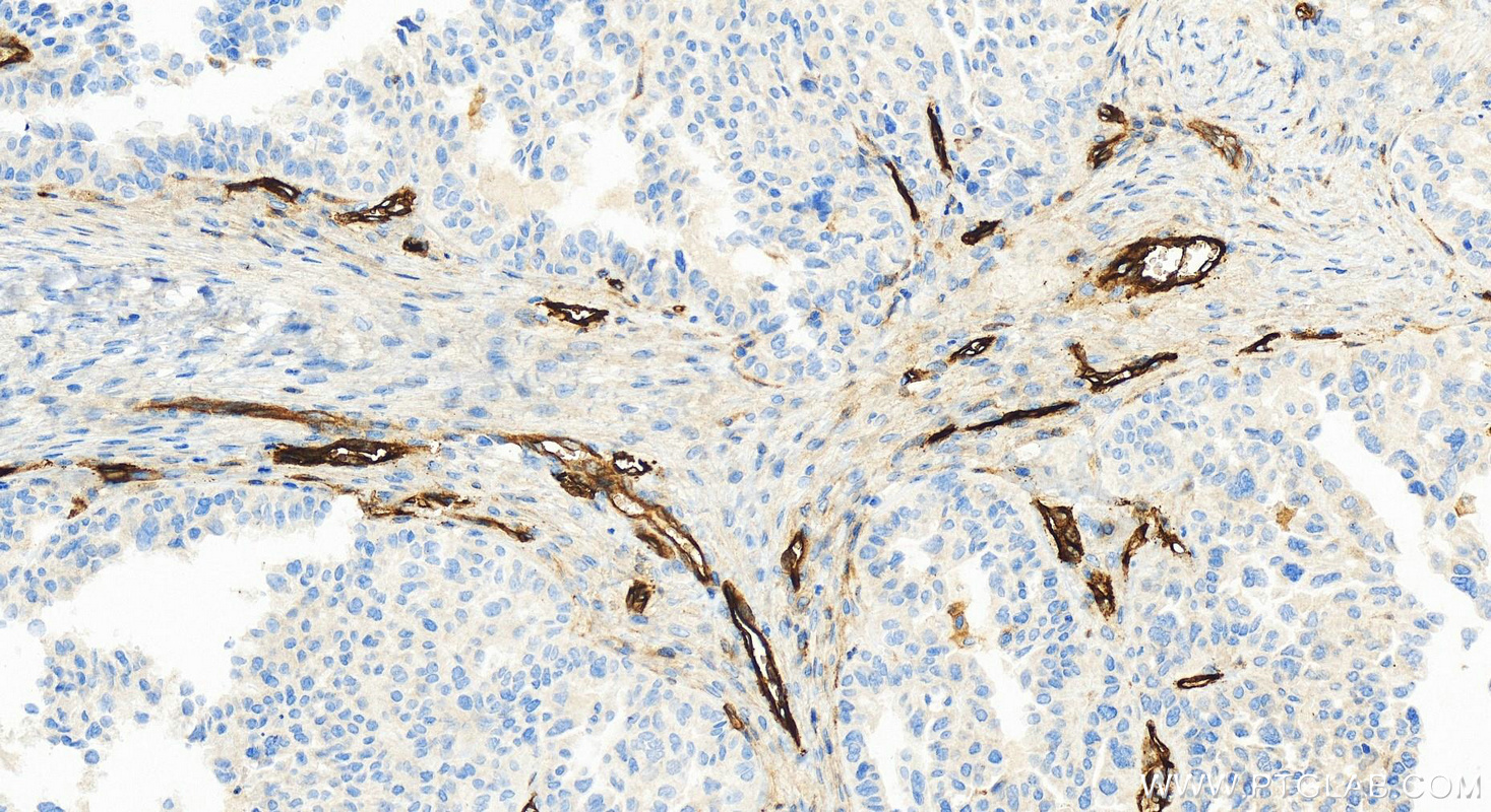 Immunohistochemistry (IHC) staining of human ovary cancer tissue using Endoglin/CD105 Recombinant antibody (82993-6-RR)