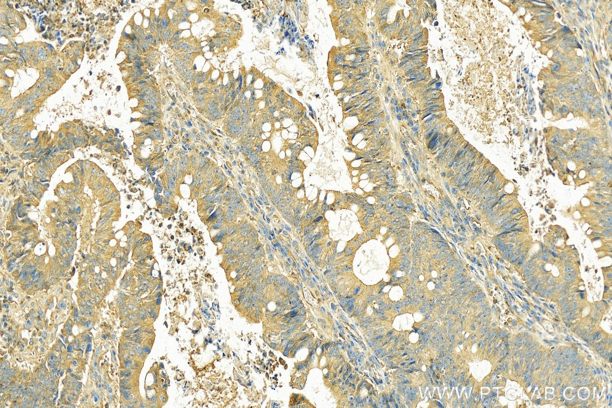 Immunohistochemistry (IHC) staining of human colon cancer tissue using FABP2 Polyclonal antibody (21252-1-AP)