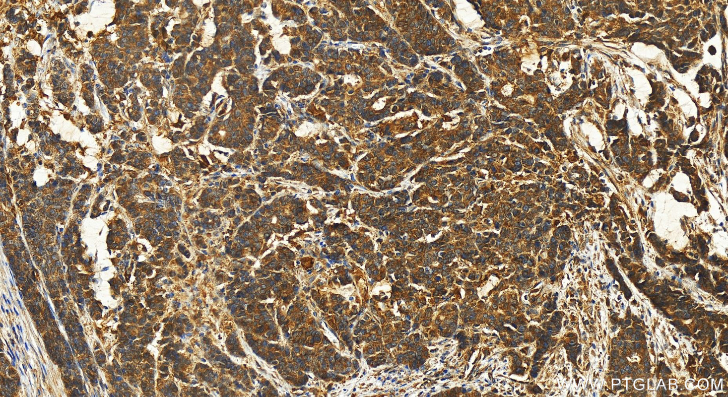 Immunohistochemistry (IHC) staining of human stomach cancer tissue using FABP2 Polyclonal antibody (21252-1-AP)