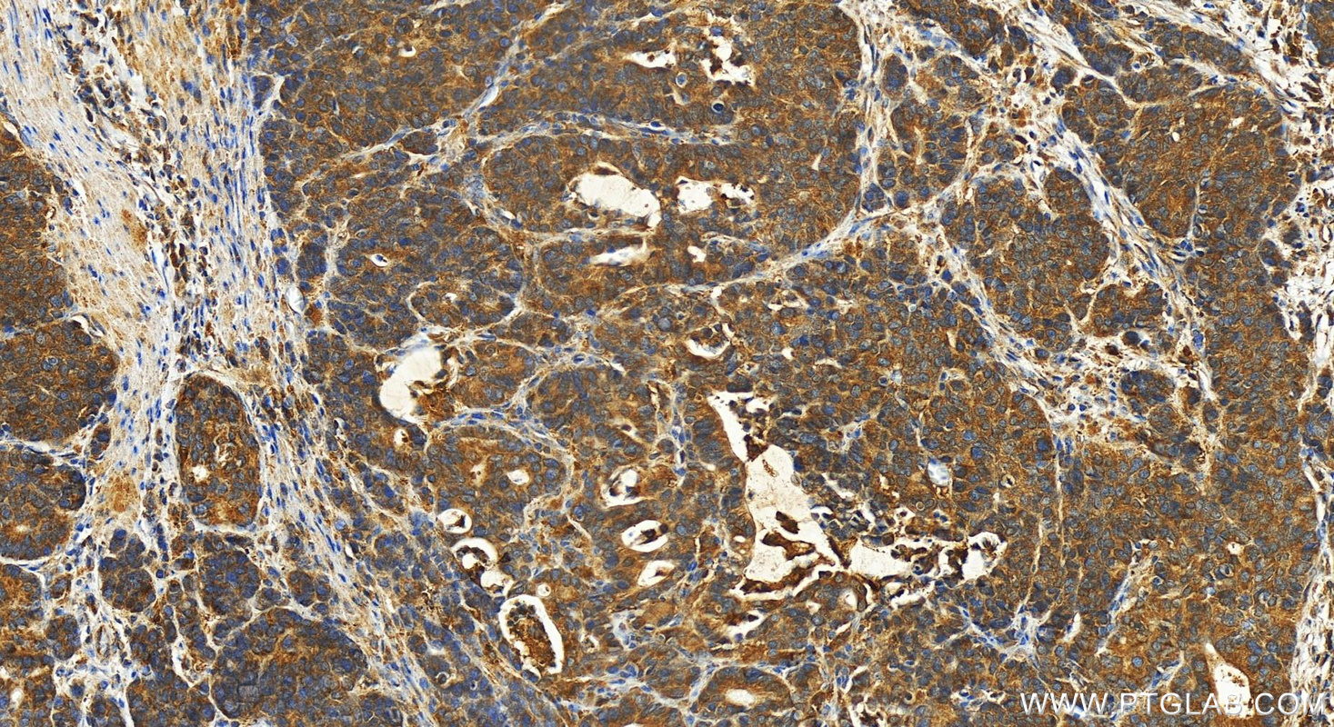 Immunohistochemistry (IHC) staining of human stomach cancer tissue using FABP2 Polyclonal antibody (21252-1-AP)