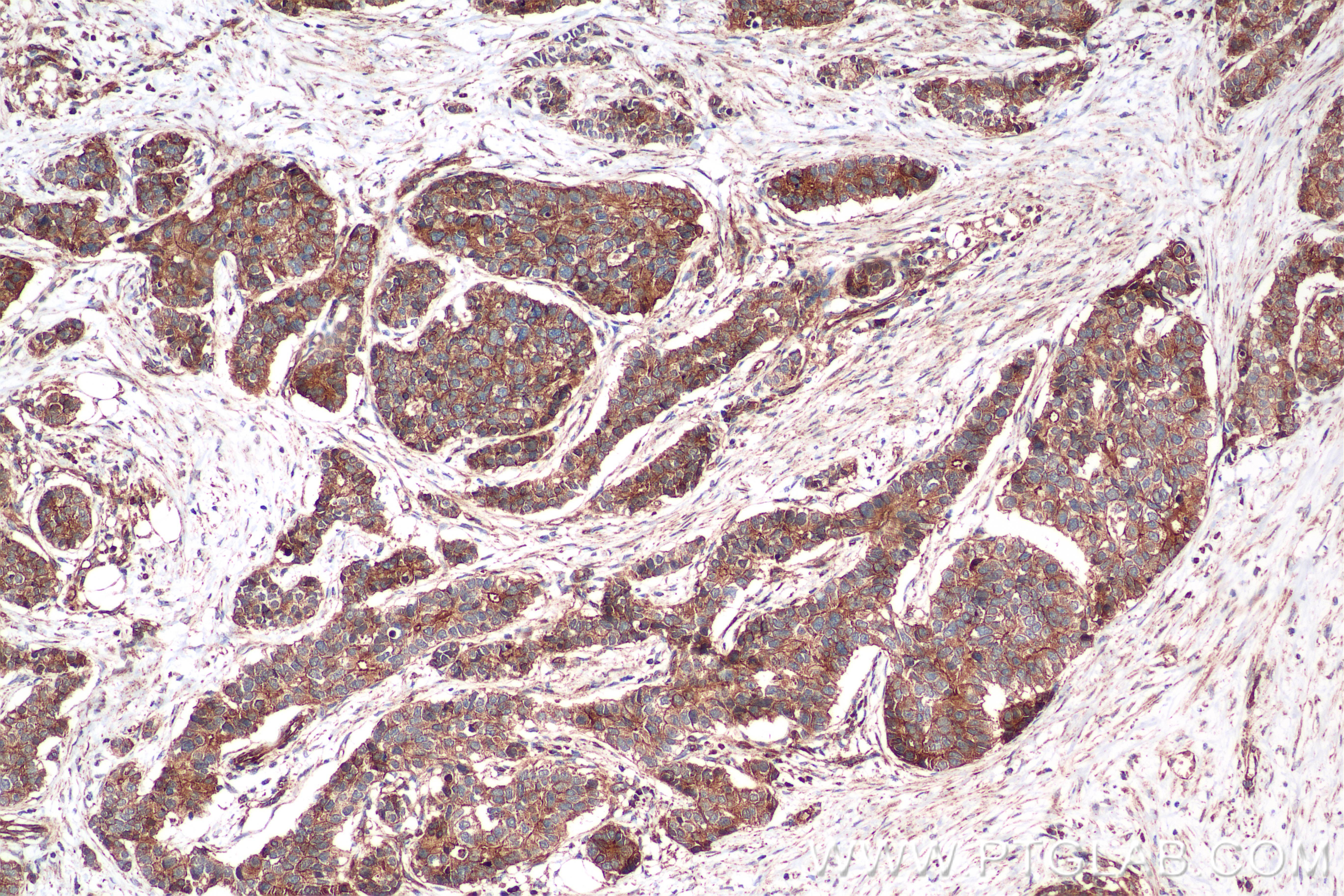 Immunohistochemistry (IHC) staining of human stomach cancer tissue using FADD Recombinant antibody (84619-5-RR)