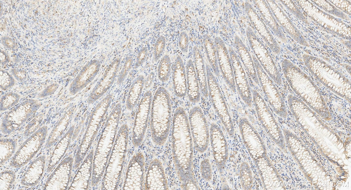 Immunohistochemistry (IHC) staining of human colorectal cancer tissue using FADS1 Polyclonal antibody (10627-1-AP)