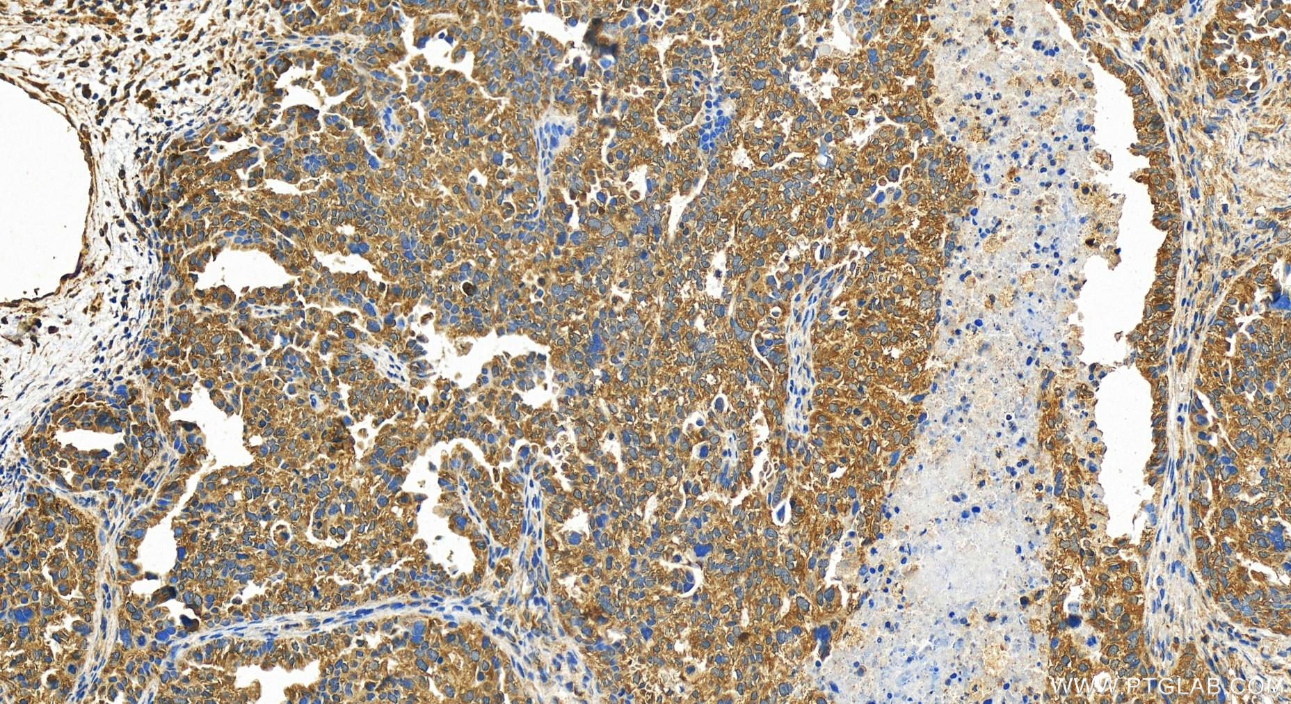 Immunohistochemistry (IHC) staining of human ovary cancer tissue using FADS3 Polyclonal antibody (15205-1-AP)