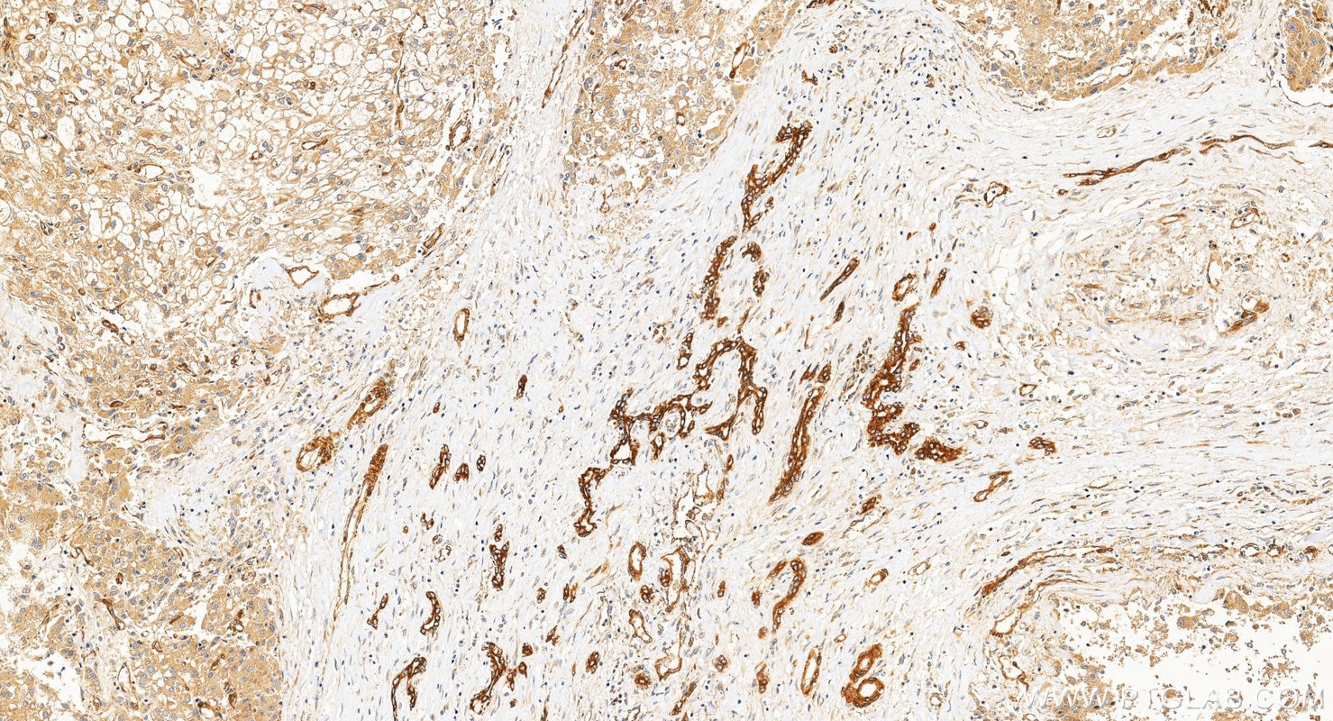 Immunohistochemistry (IHC) staining of Hepatocellular carcinoma tissue using FAK Polyclonal antibody (12636-1-AP)