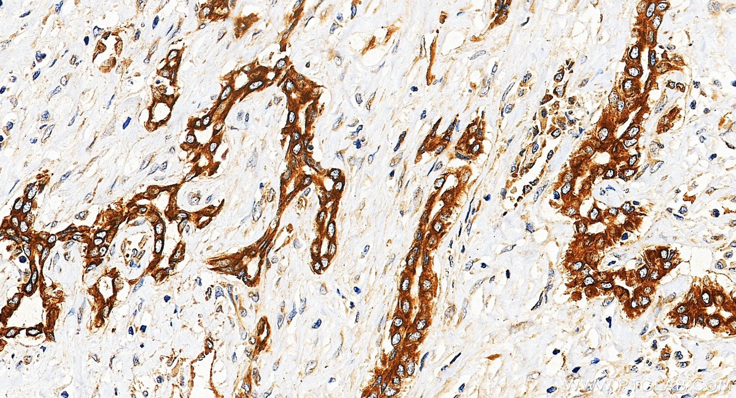 Immunohistochemistry (IHC) staining of Hepatocellular carcinoma tissue using FAK Polyclonal antibody (12636-1-AP)
