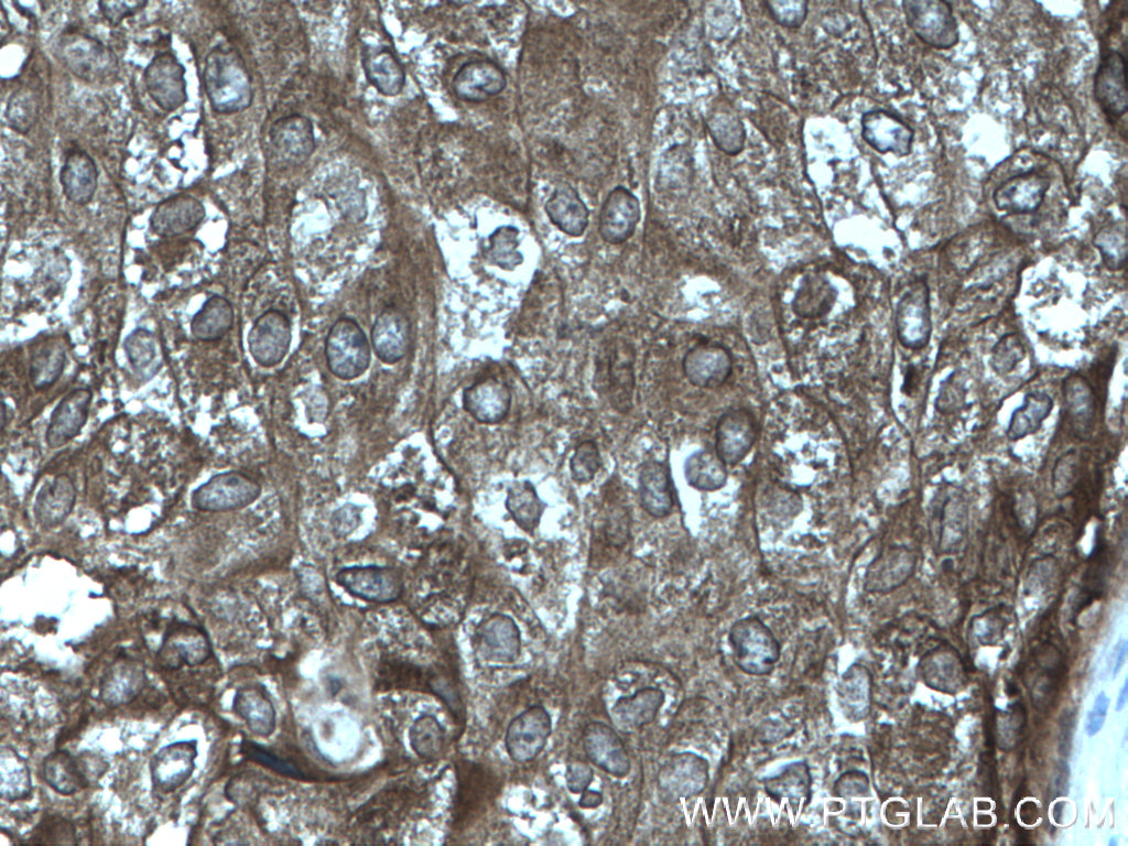 Immunohistochemistry (IHC) staining of human breast cancer tissue using FAK Polyclonal antibody (12636-1-AP)