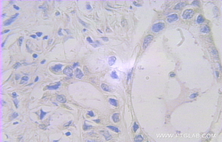 Immunohistochemistry (IHC) staining of human pancreas cancer tissue using FAM127A Polyclonal antibody (10307-1-AP)