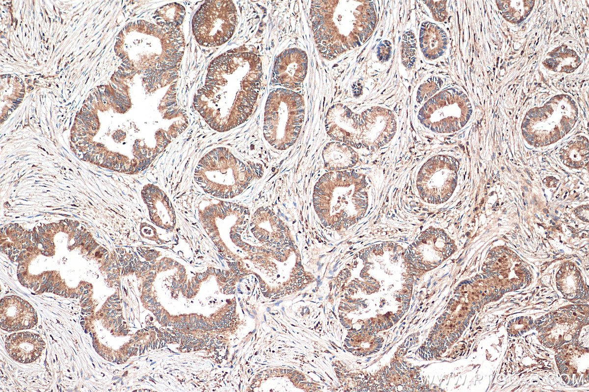 Immunohistochemistry (IHC) staining of human pancreas cancer tissue using FAM129A Polyclonal antibody (21333-1-AP)