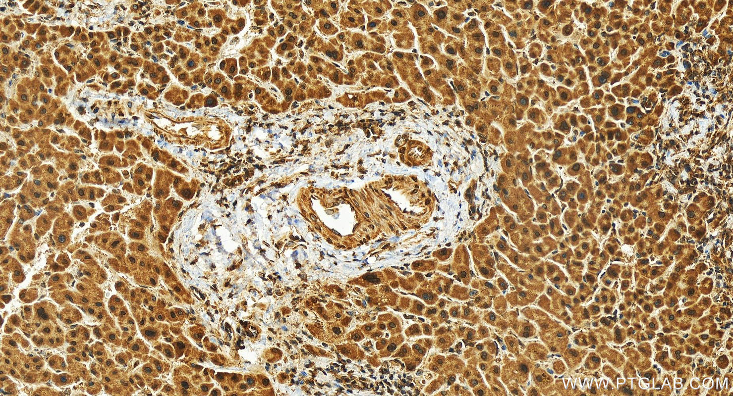 Immunohistochemistry (IHC) staining of human intrahepatic cholangiocarcinoma tissue using FAM160B1 Polyclonal antibody (25388-1-AP)