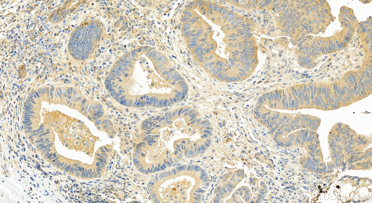 Immunohistochemistry (IHC) staining of human colon cancer tissue using FAM20A Polyclonal antibody (25258-1-AP)